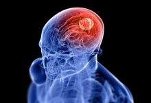 brain tumor blog photo