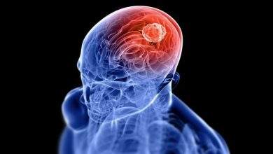 brain tumor blog photo