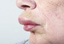 allergic reaction on lip causing swelling 1