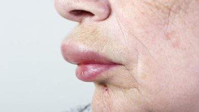 allergic reaction on lip causing swelling 1