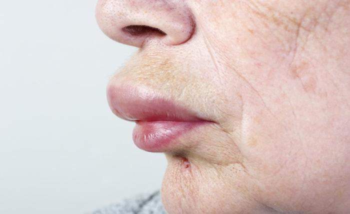 allergic reaction on lip causing swelling 1
