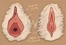 vagilangelo solution for post delivery laxity