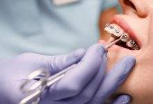 How Early Dental Correction Can Prevent Future Orthodontic Issues